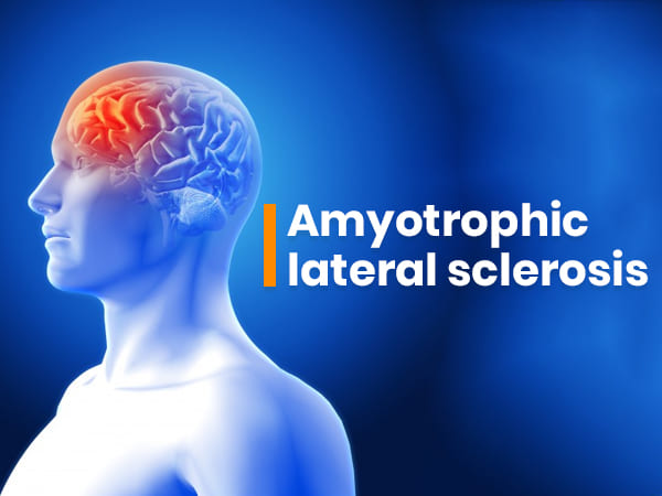 pcd franchise for amyotrophic lateral sclerosis drug